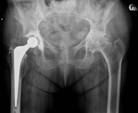 An X Ray of a hip replacement. 