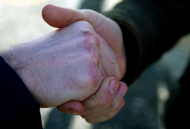 Fianna Fail candidate Charlie McConalogue's knuckles grazed from hand shaking on his canvass of the newly enlarged Donegal constituency. He was pictured meeting farmers at Milford Livestock Mart on Wednesday.
